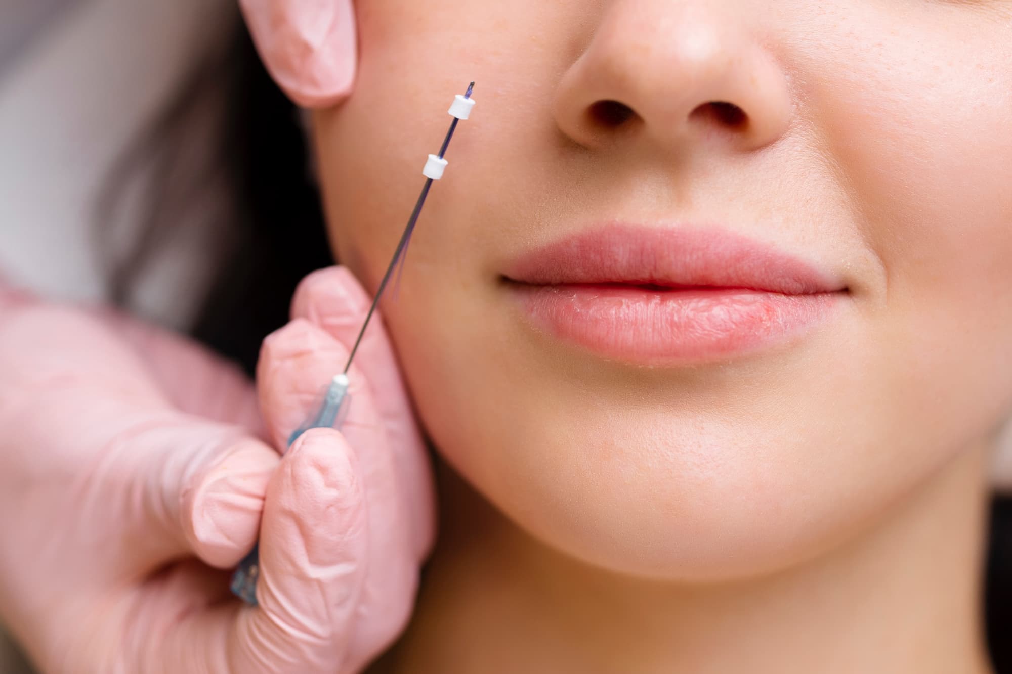 woman having a thread lift treatment