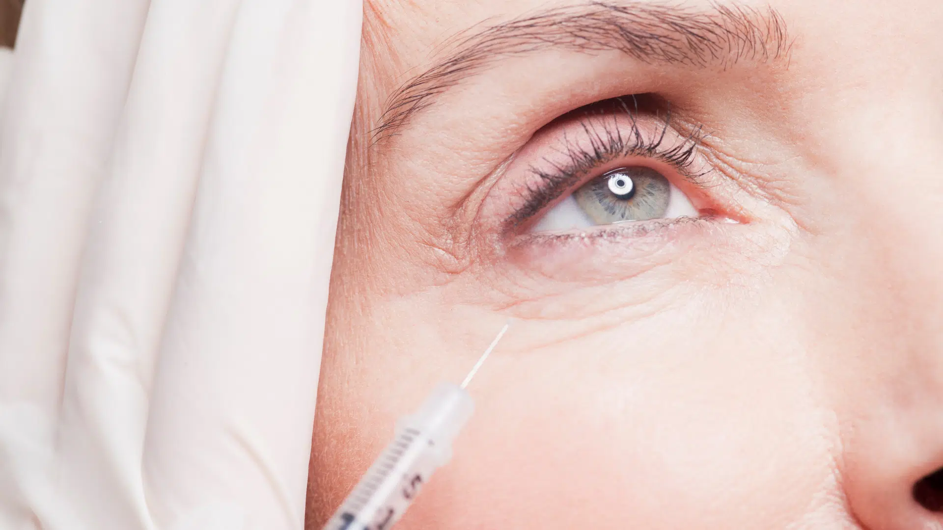 Benefits of Belotero for Under Eyes What You Need to Know