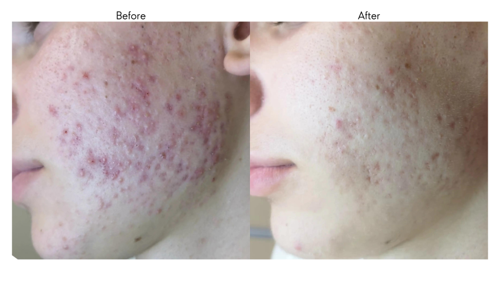 An individual completed a BioRePeel FND chemical peeling treatment, aiding their skin acne problems.