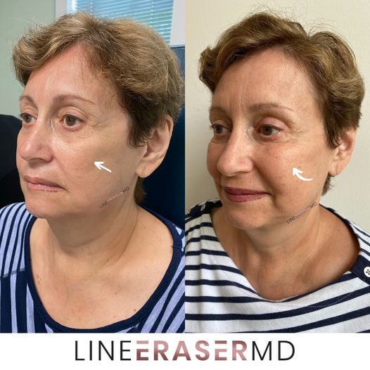 A bfore-and-after photos of an individual who had a Botox injection for cheek lift.