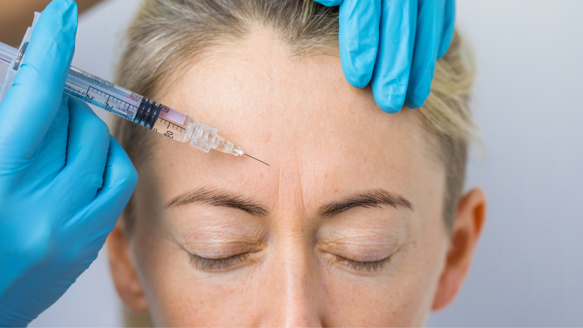 A medical professional injecting Botox in between the eyebrows area.