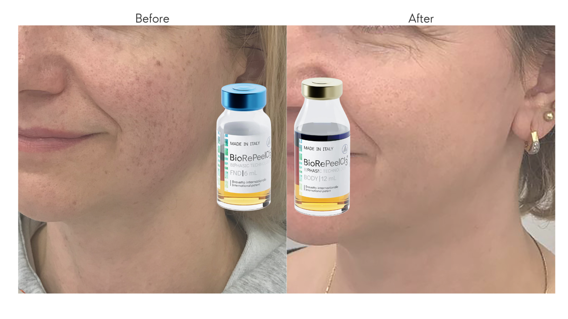 A before and after photos of the patient who had undergone a Biorepeel chemical peel treatment.