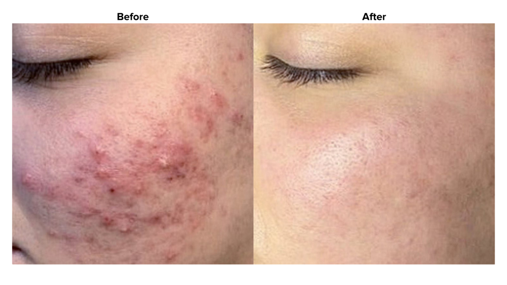 A patient's before and after photos of their Biorepeel chemical peel treatment to alleviate the appearance of acne.