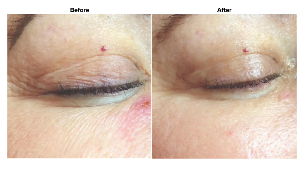 The lines on patient's eye area lessened its visibility after a Biorepeel chemical peel procedure.