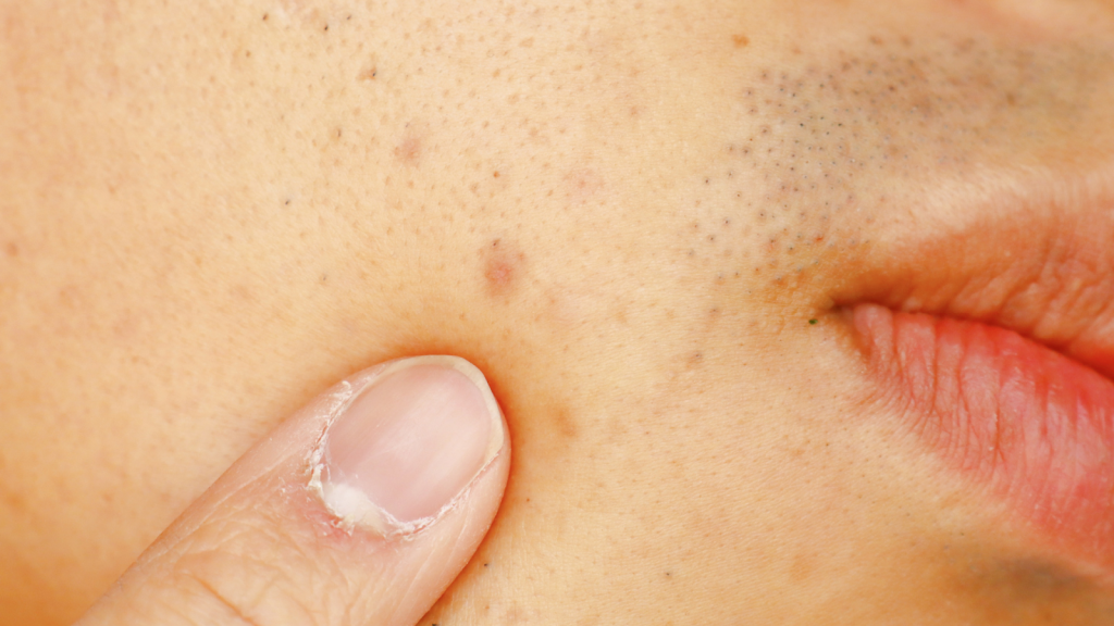 An individual dealing with hyperpigmentation on their facial skin.