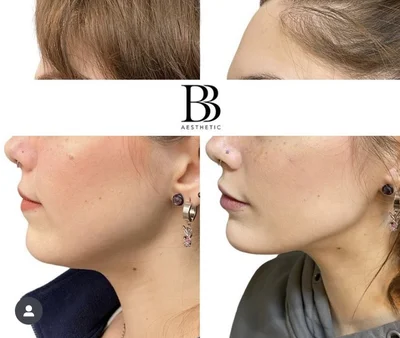 The Juvederm contour effects can be seen on the patient's jawline.