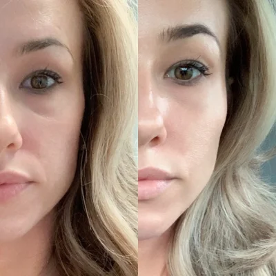 A patient's before and after photos of her Juvederm contour treatment.