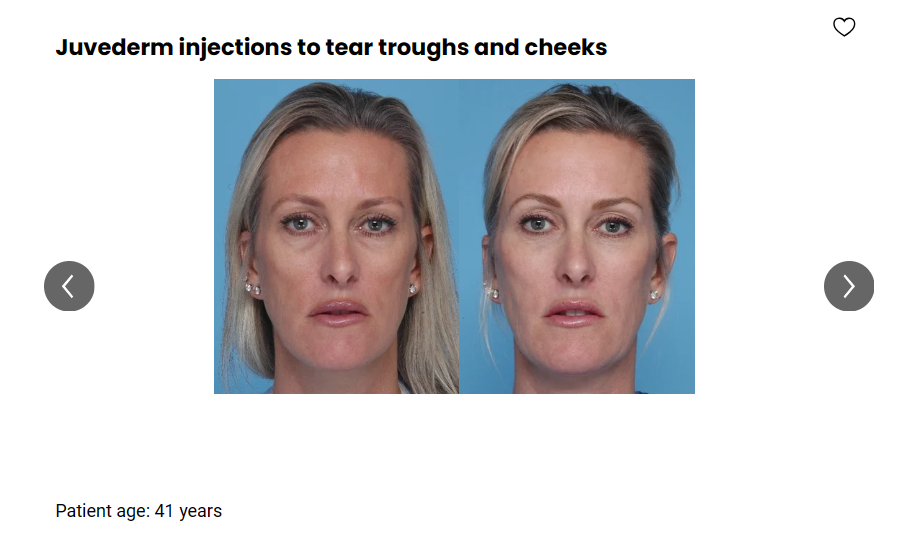 A patient received Juvederm injections to treat tear troughs and cheeks.