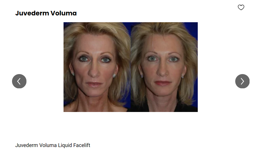 A patient received a Juvederm liquid facelift with Voluma XC.