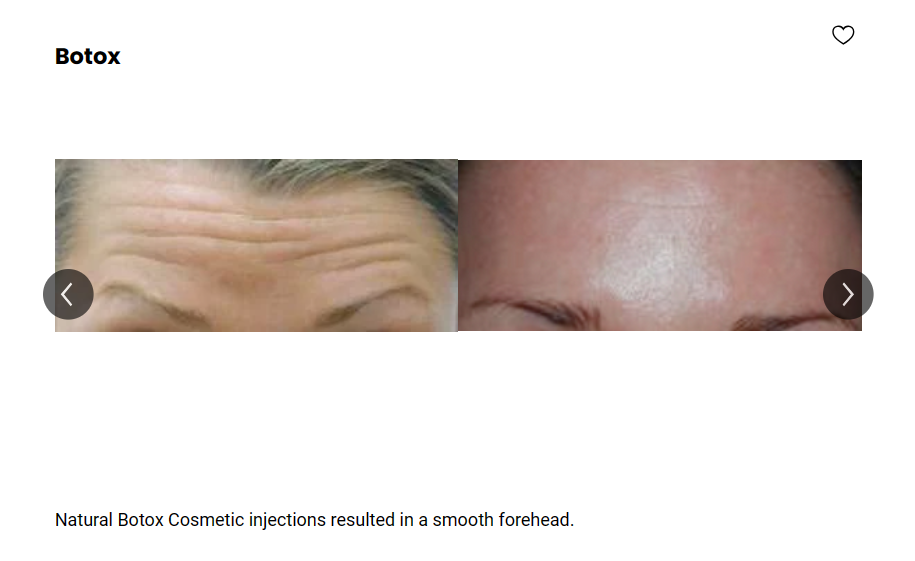 A patient's forehead became smoother and wrinkle-free-looking after a Botox treatment