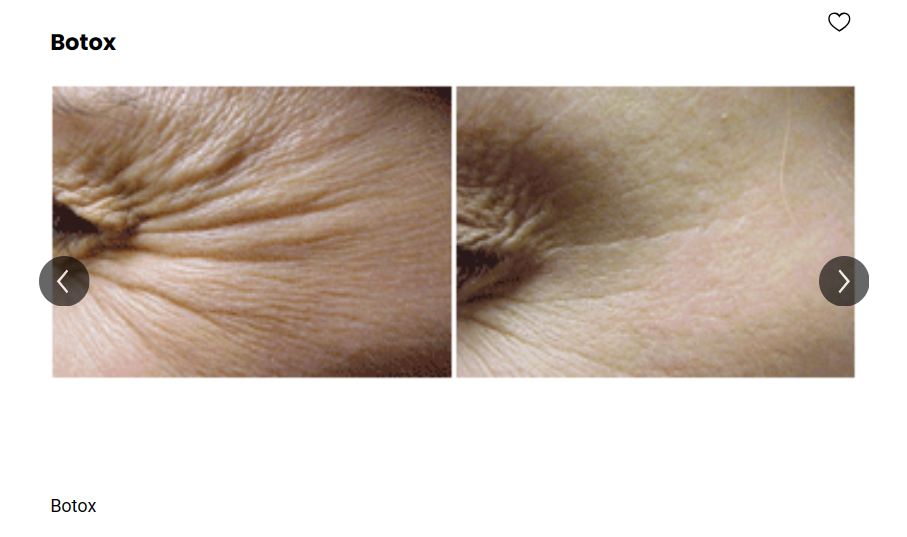 An individual's before and after photos of their Botox treatment to treat the lines on the corners of the eyes.