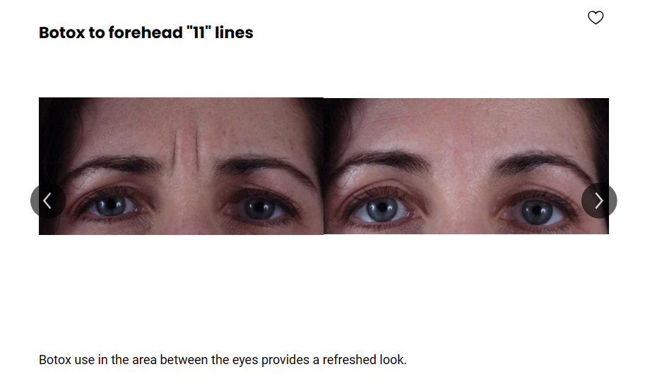 The '11' between the eyebrows of an individual was temporarily removed after a Botox treatment.