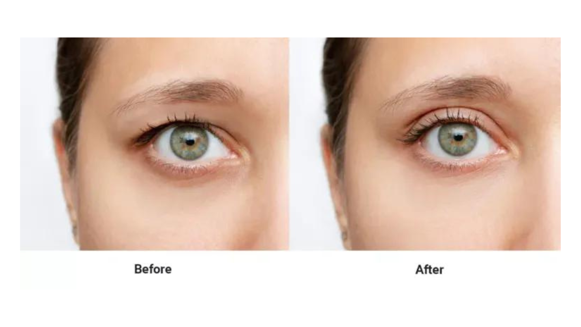 Before and after photos of a Botox eyelid lift injection.