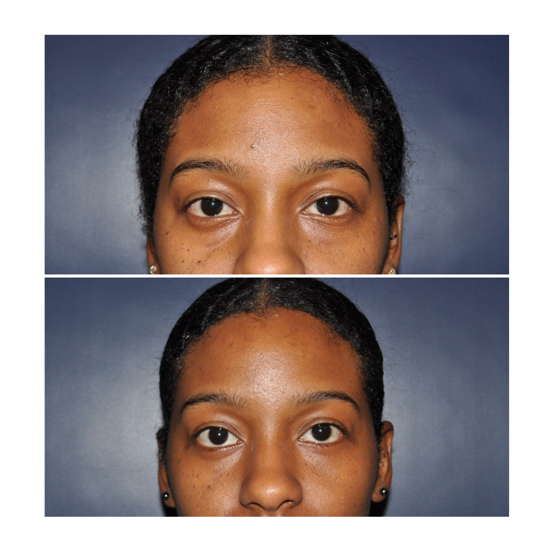 A younger individual received Botox treatment that helped lift her eyelid.