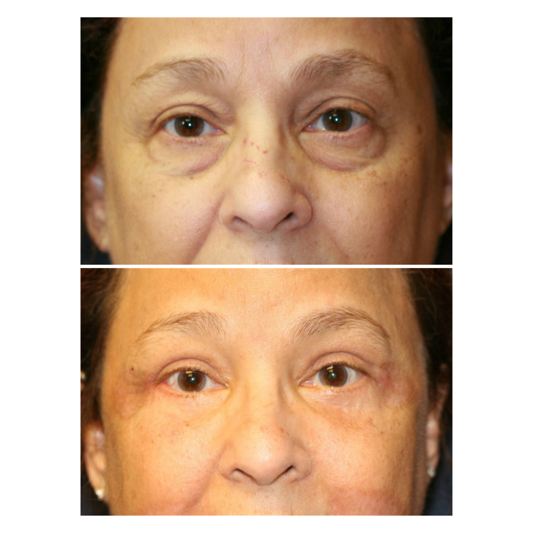 An older individual treated her signs of aging that also lifted her eyelid.