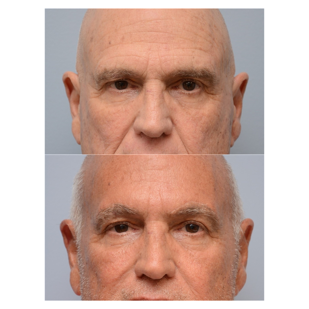 A before-and-after photos of a man who had a Botox injection on their facial skin.