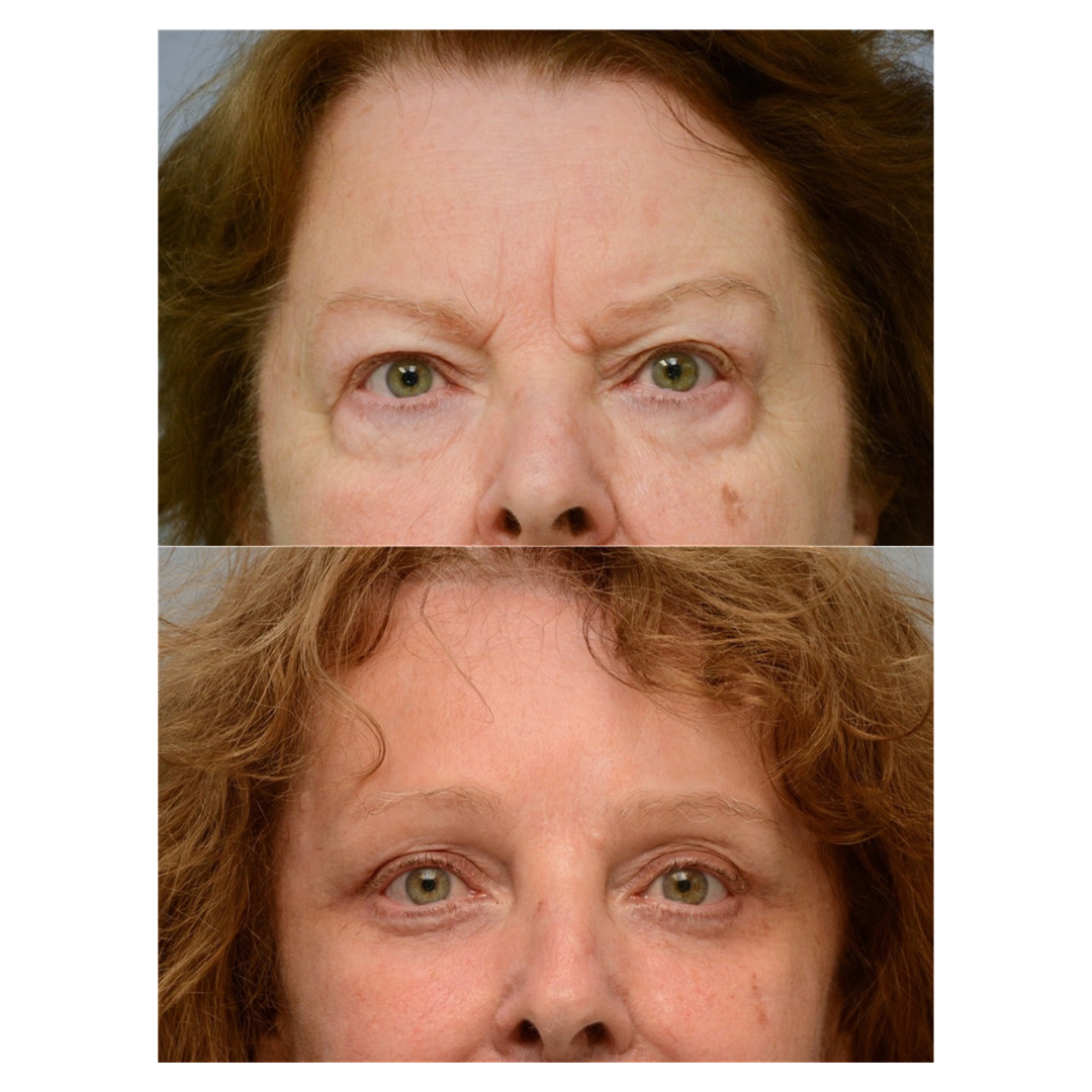 An individual had undergone a Botox injection for a subtle cheek lift.