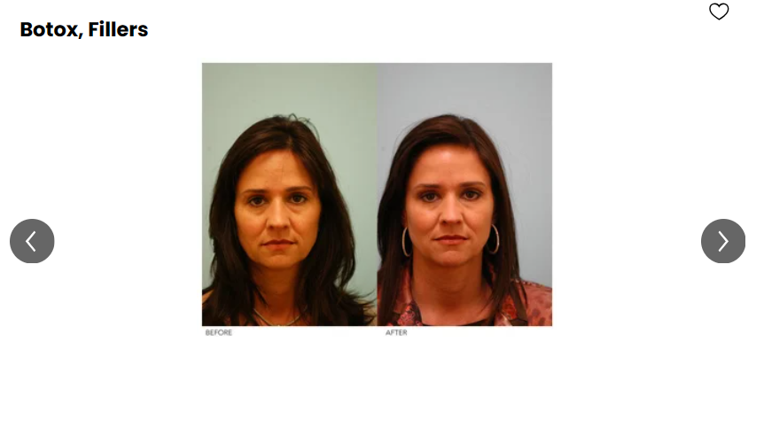 A patient's before-and0after photos showing their skin looked tightened after Botox and filler treatments.