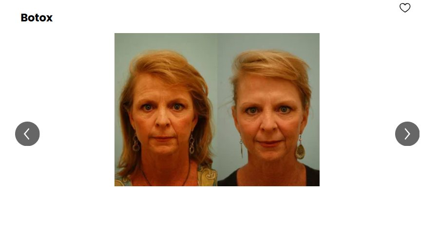 A before-and-after photo of a middle-aged woman looking like their skin tightened.