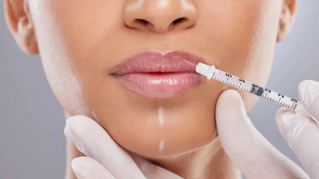 A patient receiving an injection into the upper lip.