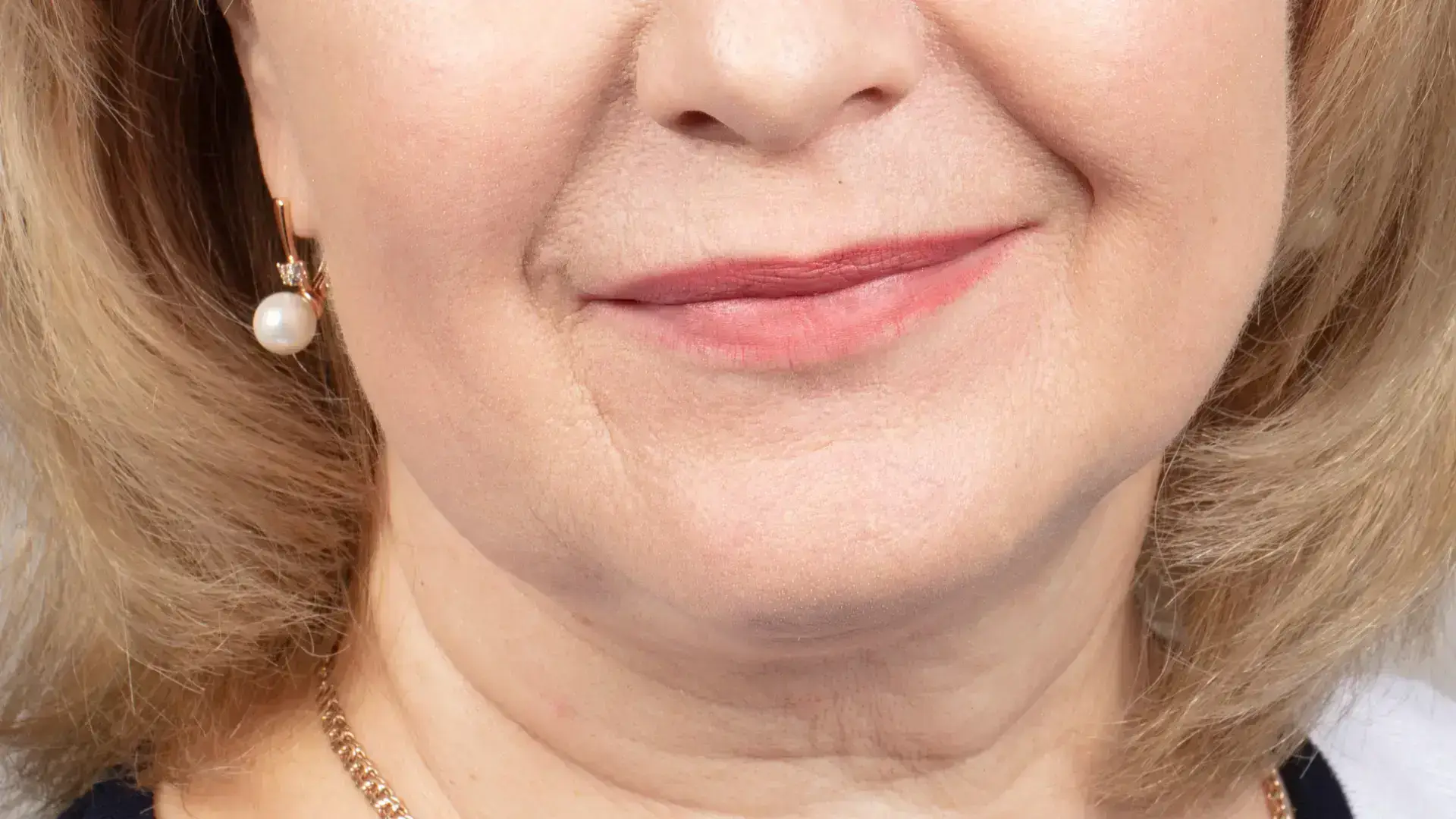 An individual with signs of aging noticeable in their cheek or midface area.