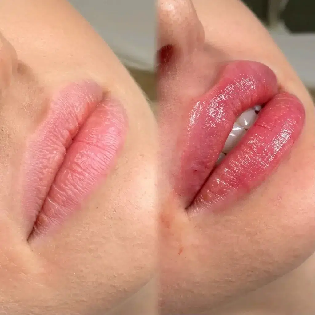 A patient flexing their fuller and plumper lips.