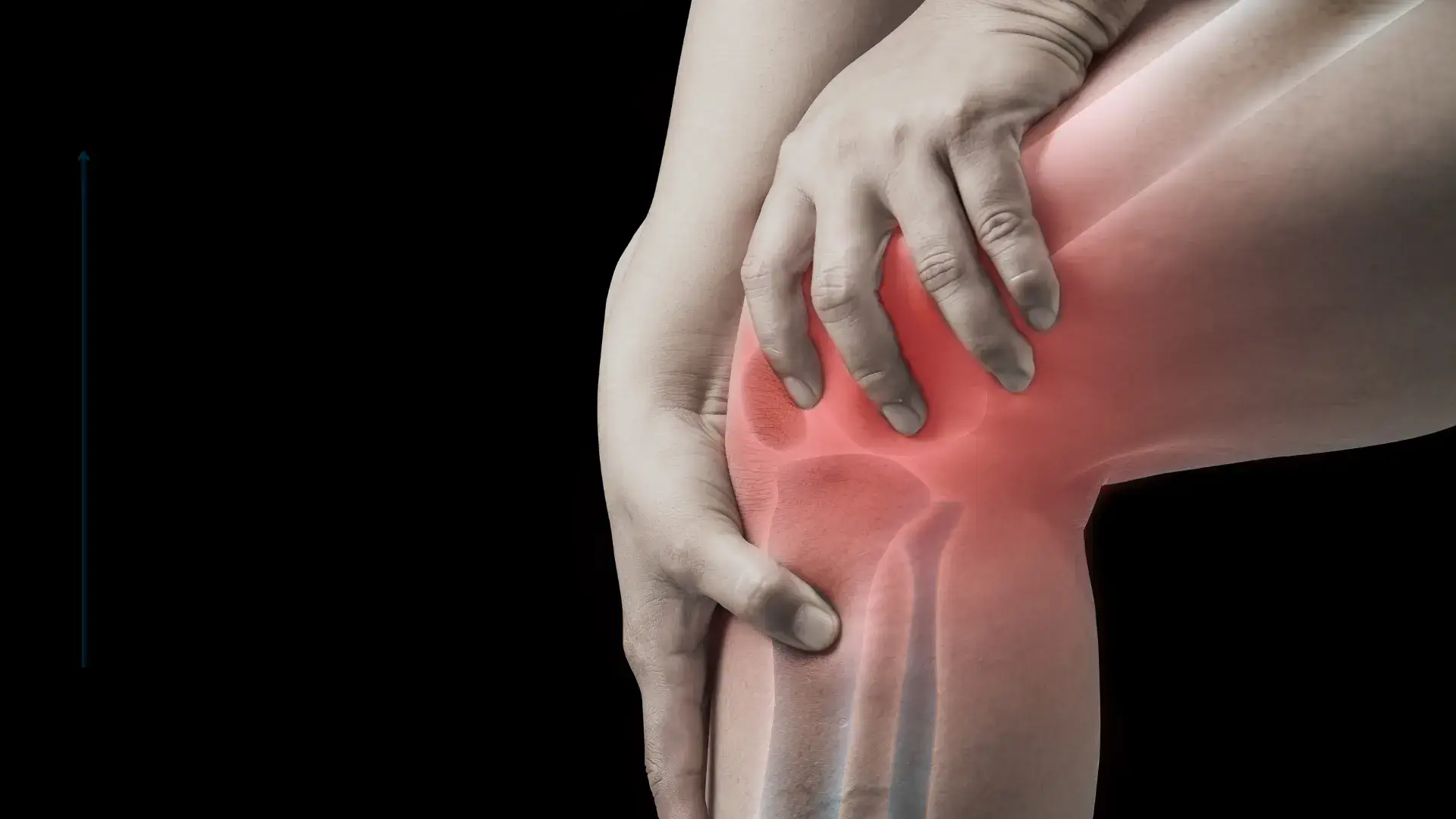 An individual suffering from knee pain or joint inflammation.