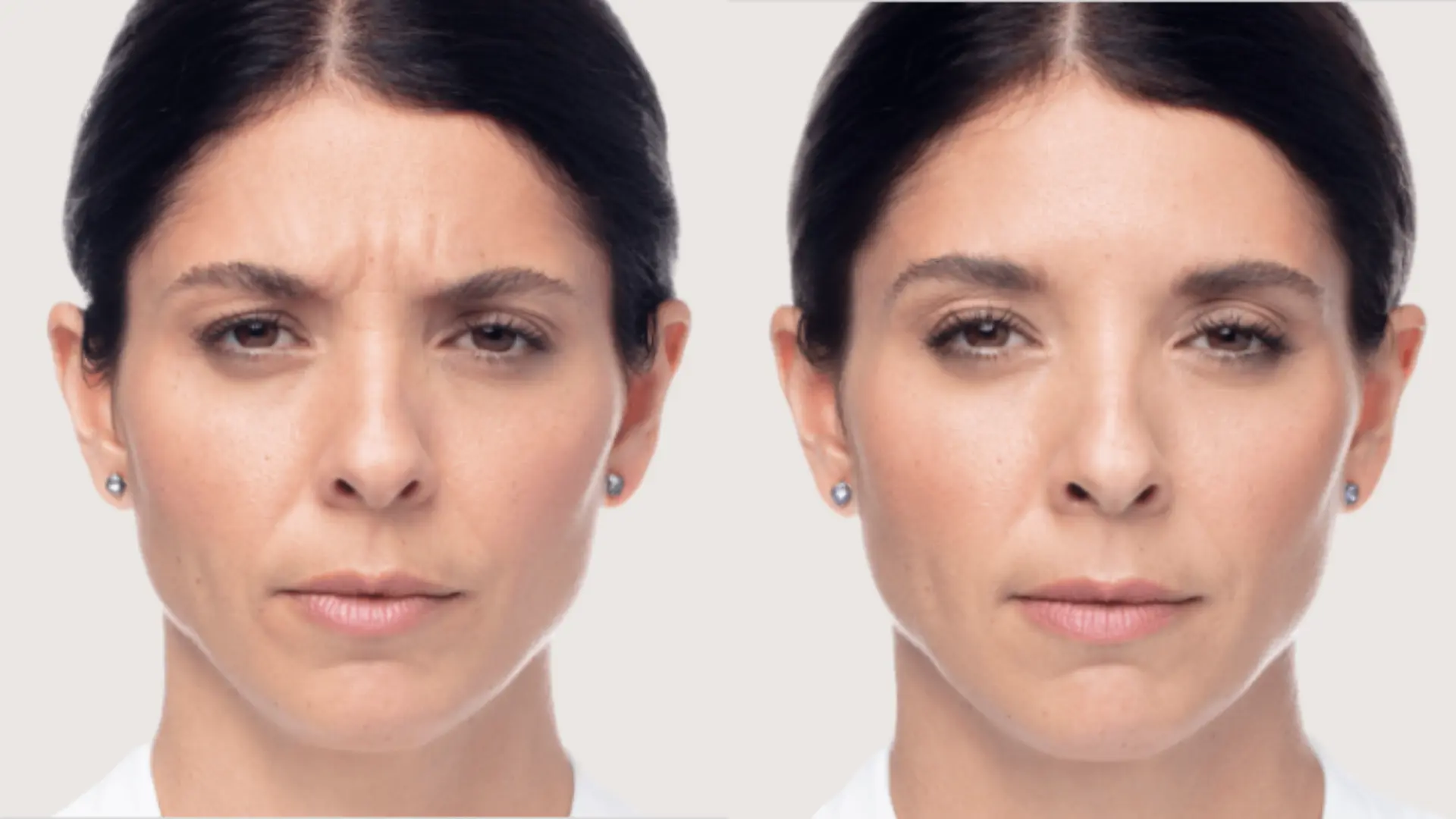 A before-and-after photo of a Dysport-treated patient.