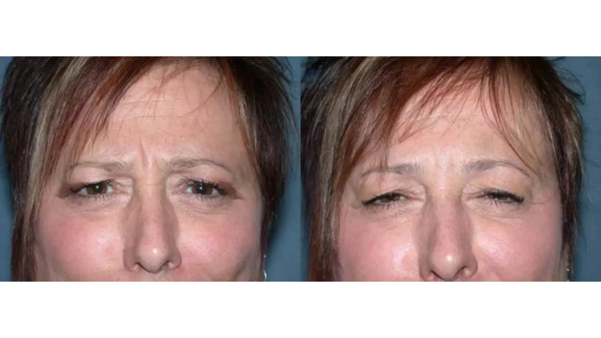 An individual experienced significant improvement in their eyebrow area after Dysport injections.