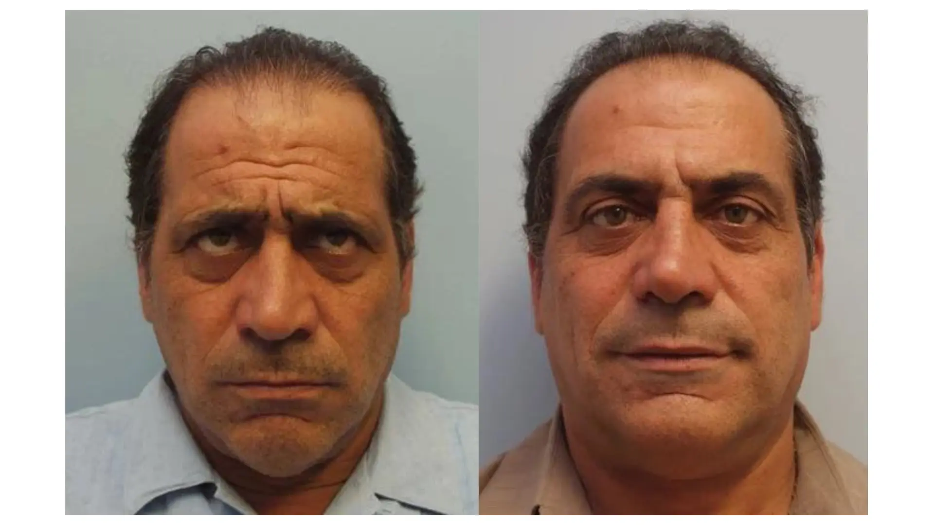 A male individual's before-and-after look of their Dysport injections for glabella lines.