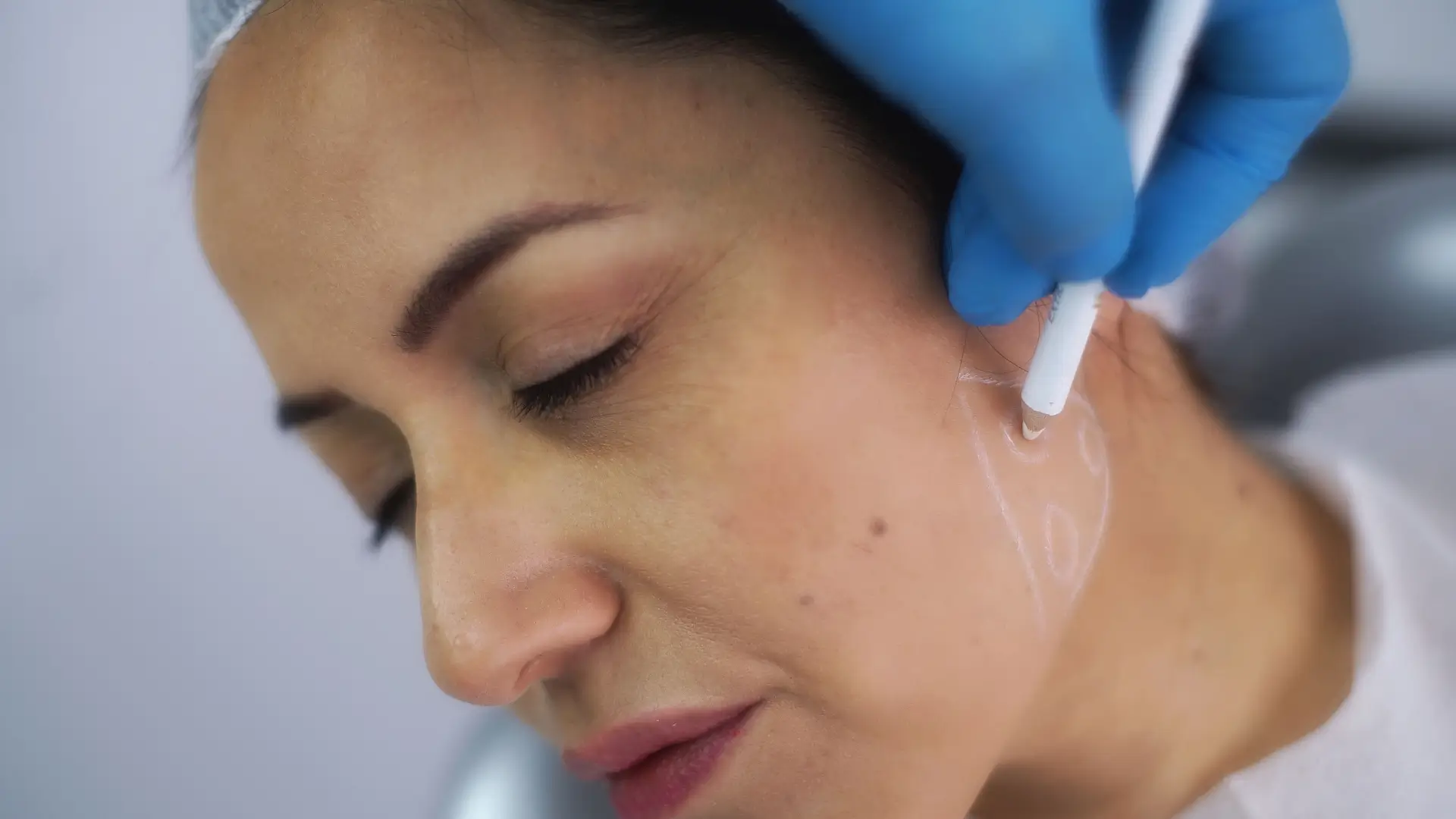 A healthcare provider marking the injection sites for the treatment.