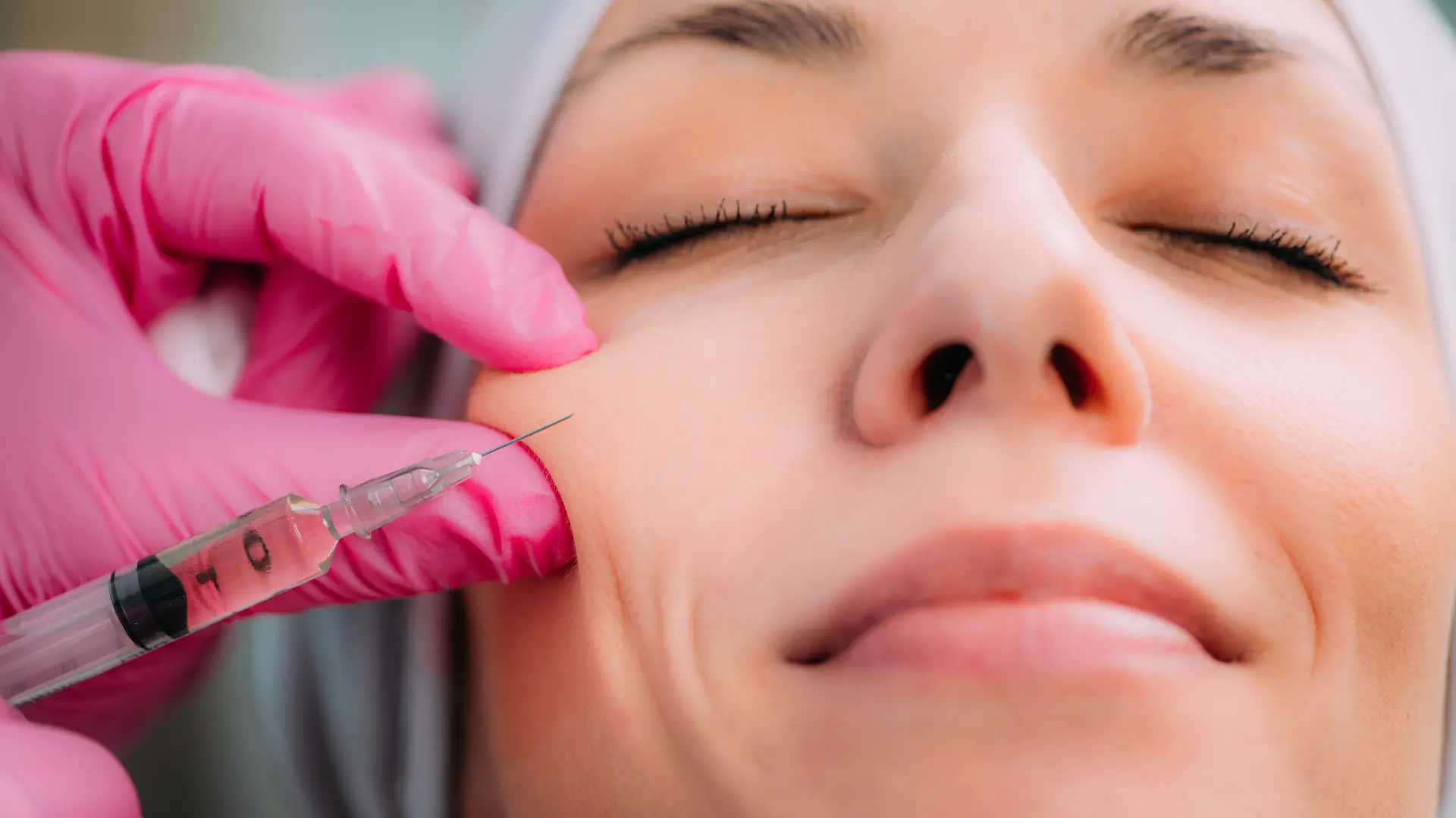 A healthcare provider injecting a dermal filler to a patient's facial region.