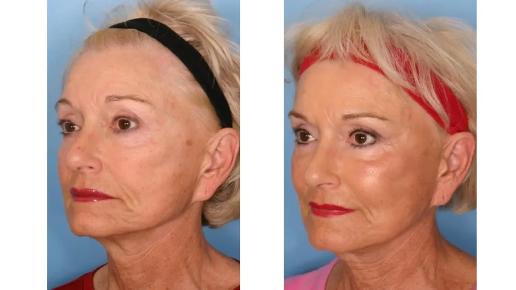 A patient's before and after photo of their Sculptra cheekbones treatment.