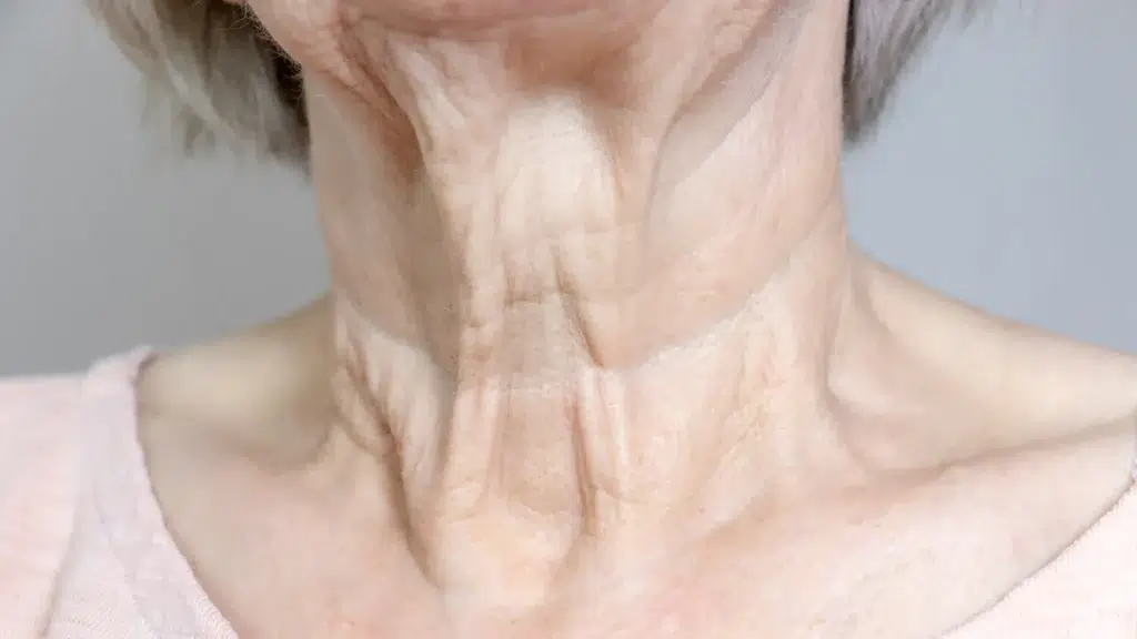 An older individual's neck with visible wrinkles and sagging skin, which Sculptra for neck can help.