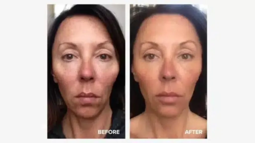 A patient's before and after photo of their Sculptra treatment, showing their revitalized appearance.