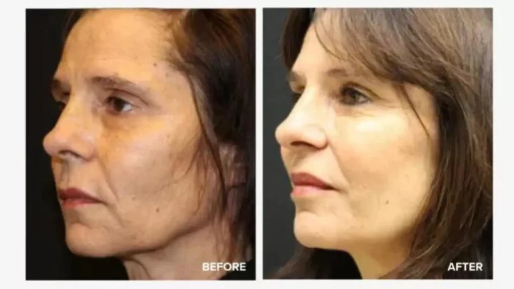 A Sculptra-treated patient's before and after photos, showcasing their refreshed and lifted cheek look.